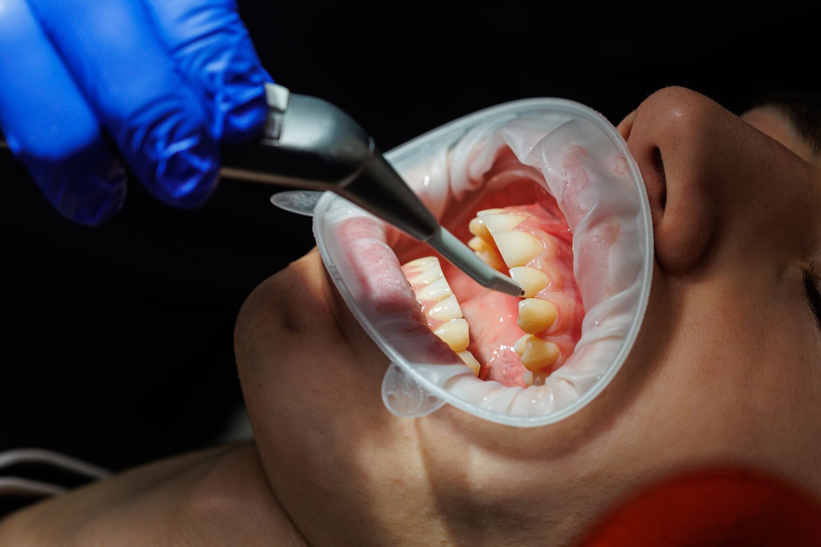 Close-up of teeth, dental checkup in the dental office. The dentist examines the patient's teeth with dental instruments. Dentistry. selective focus
