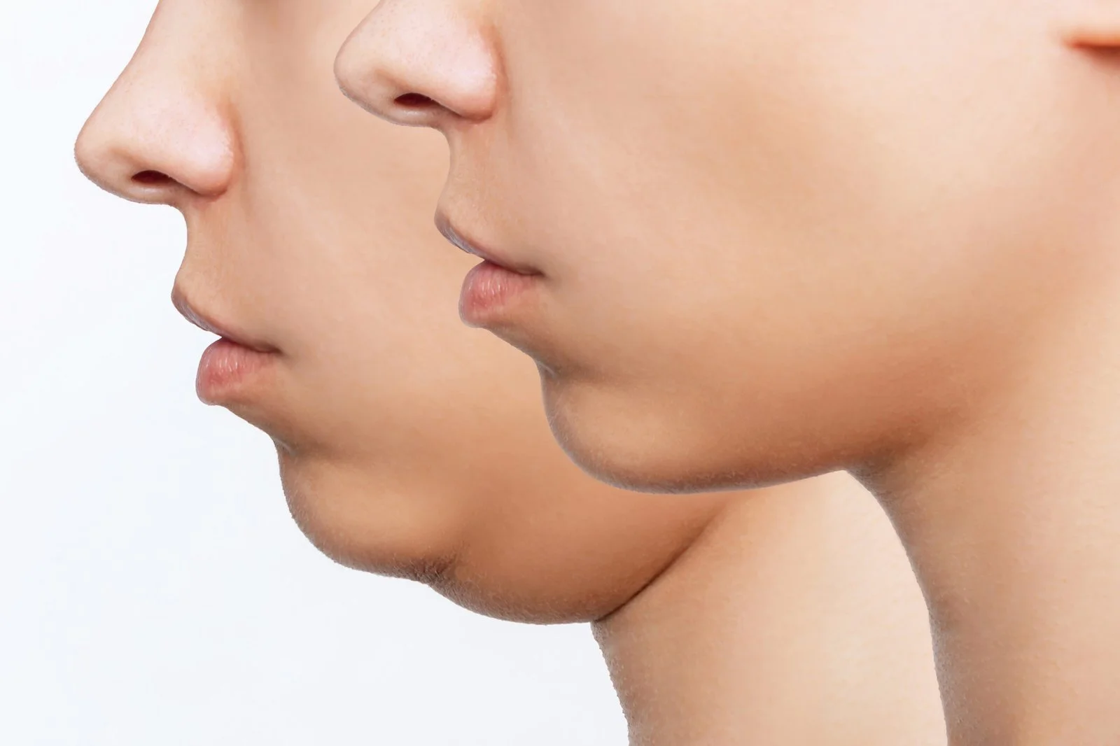 Kybella® Fat Reduction Therapy