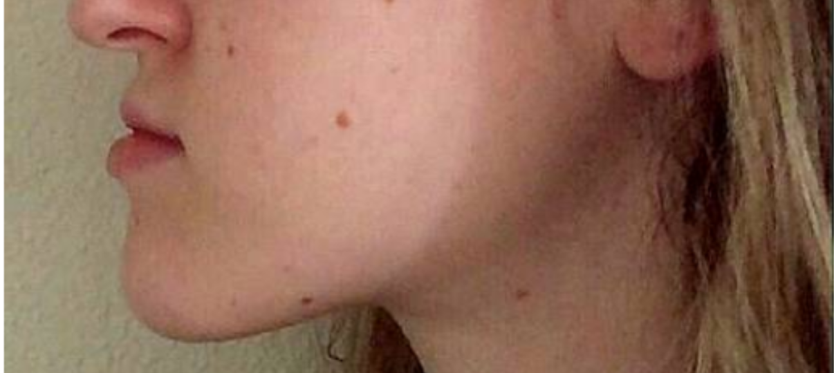 Before Treatment