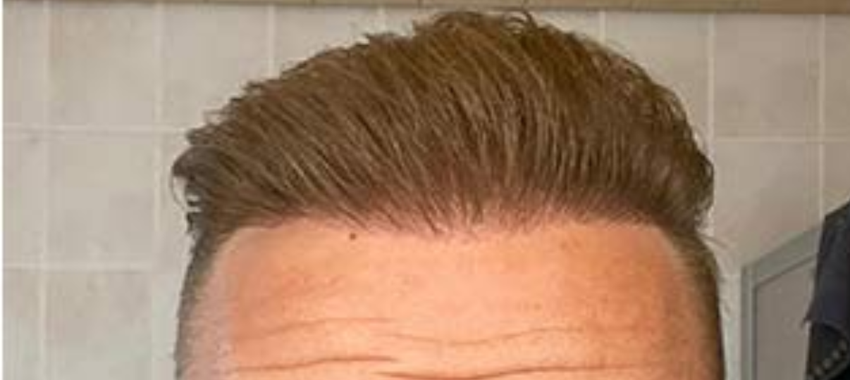 After Treatment