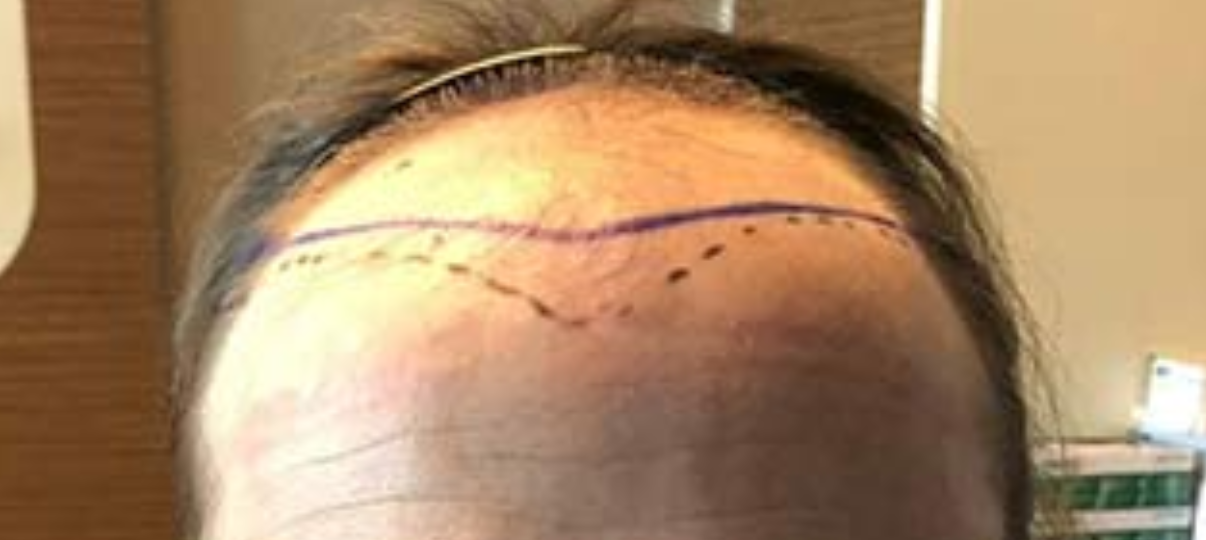 Before Treatment