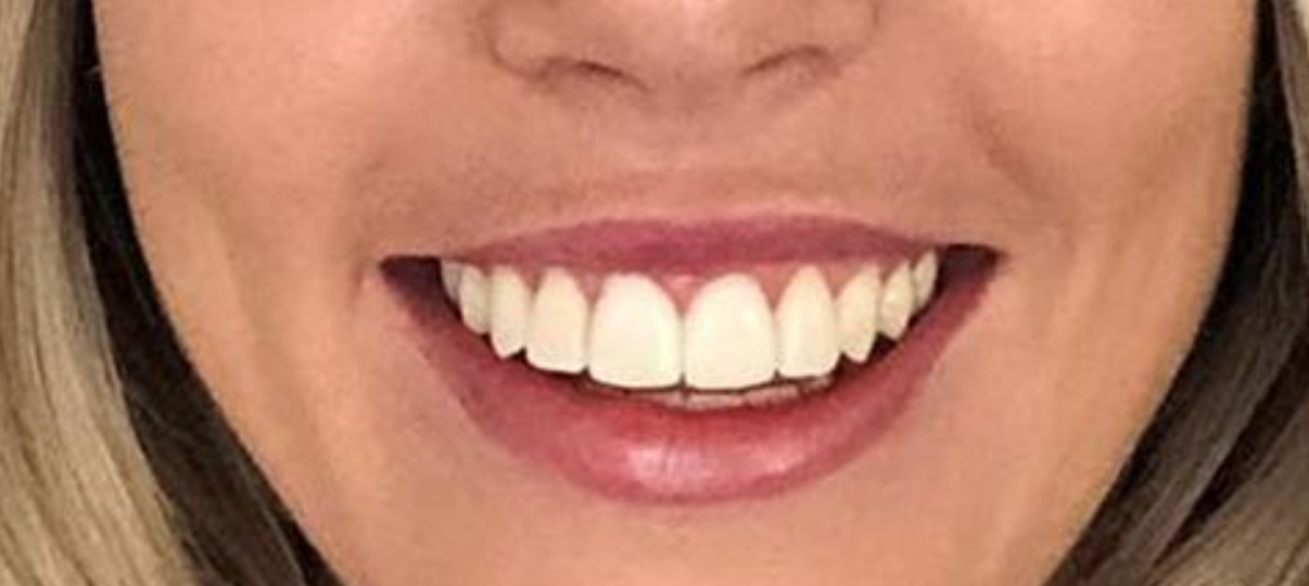 After Treatment