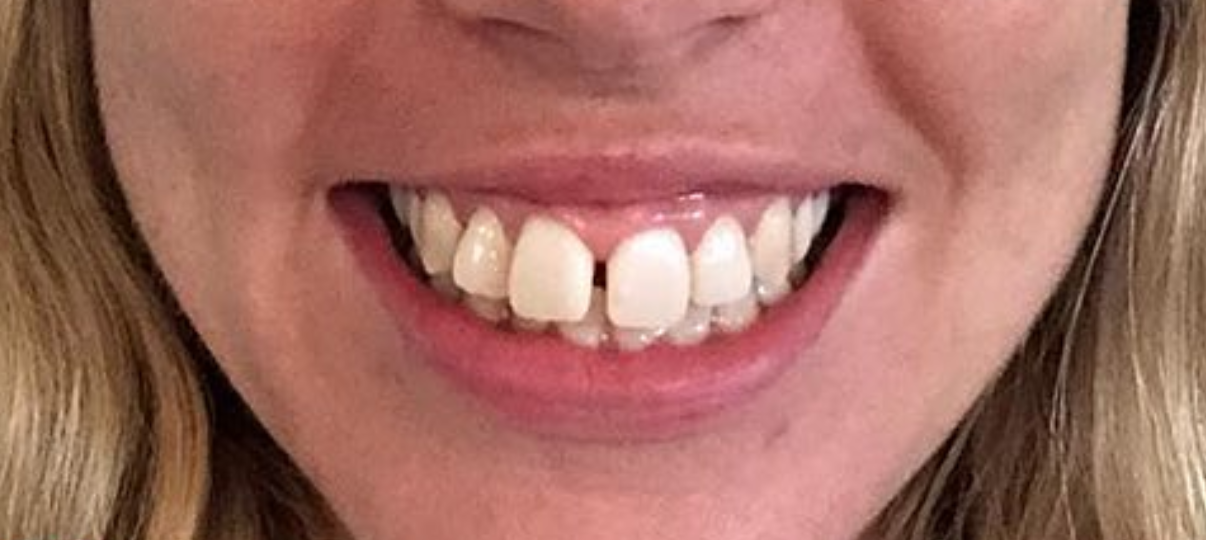 Before Treatment