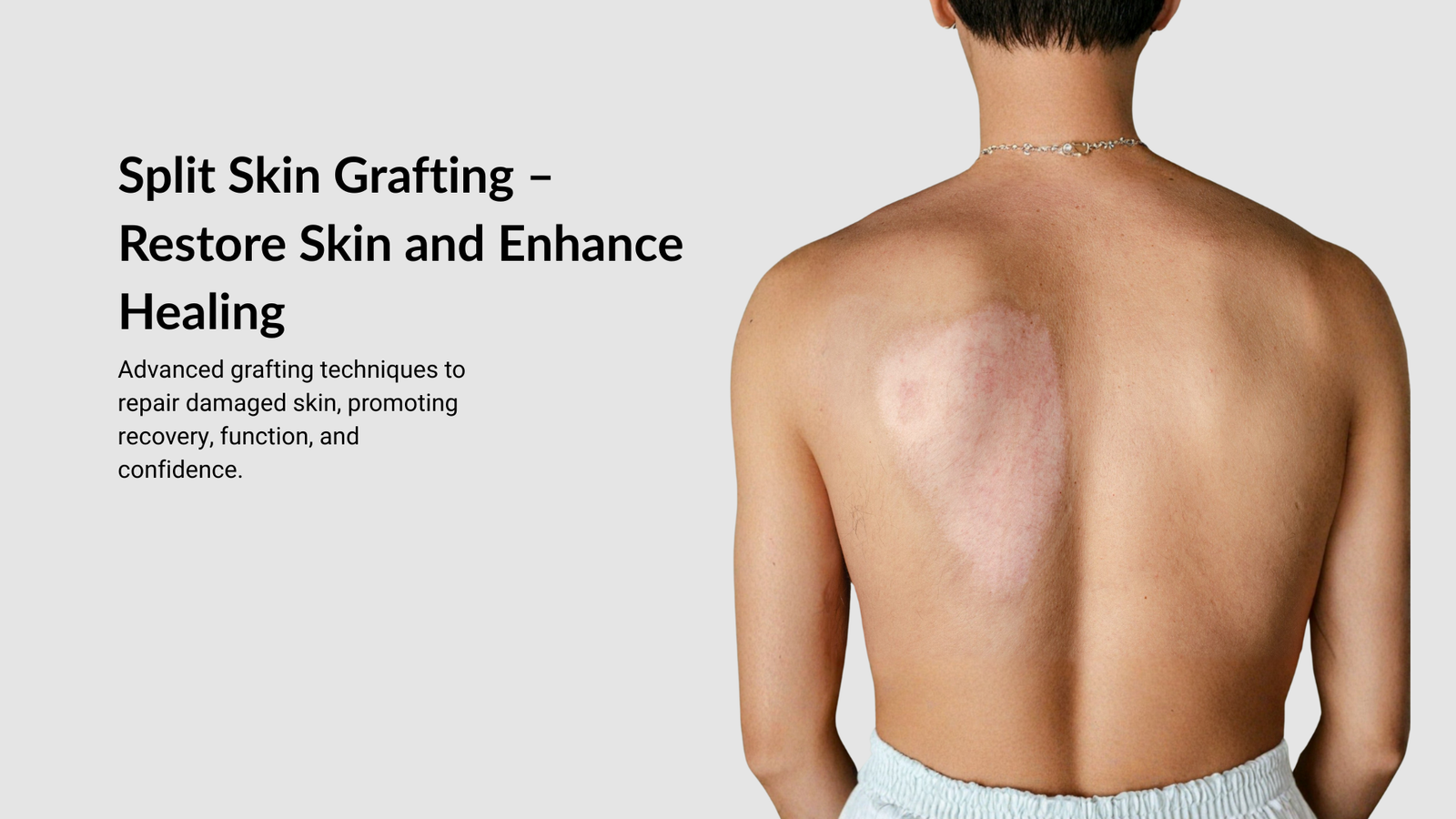 Split-Skin-Grafting-SSG