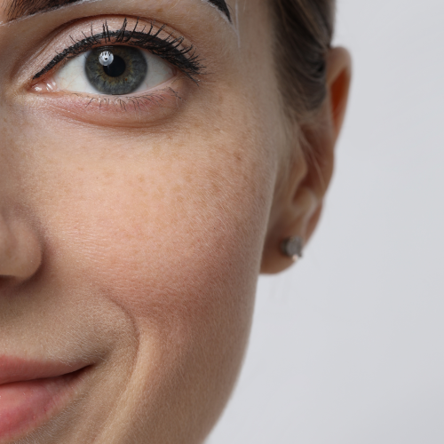 eye brow surgery (2)